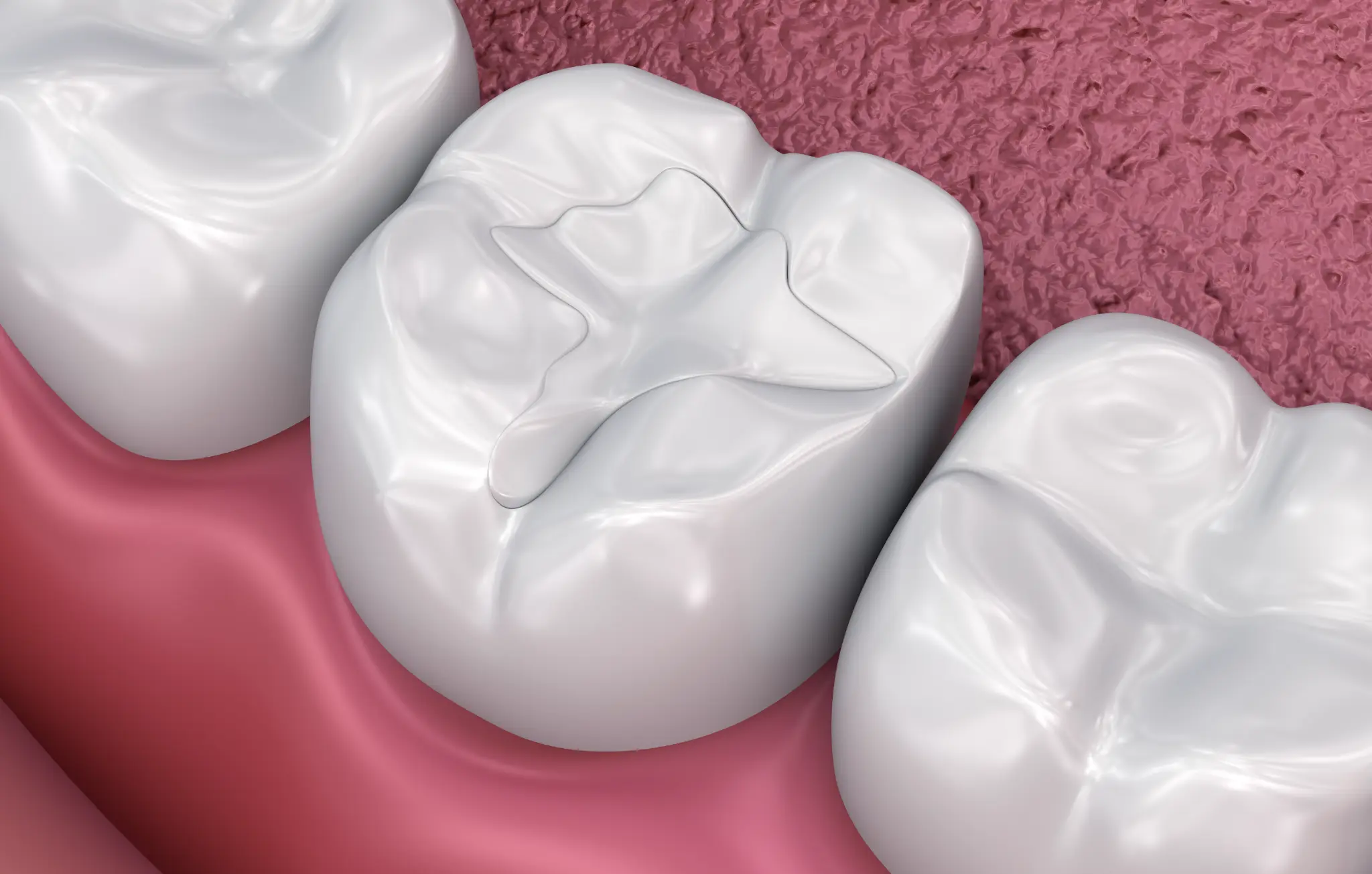 Tooth-colored composite filling — Dental Services at Accent Family Dentistry in Angier NC