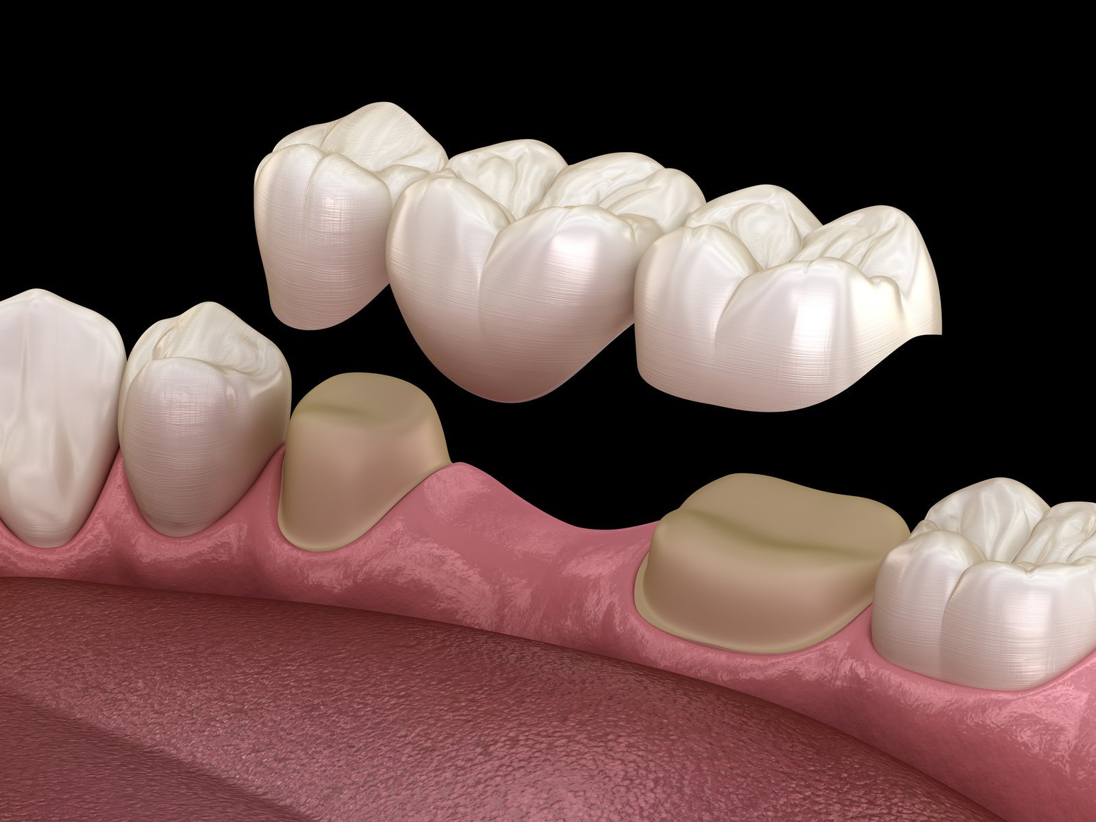 Dental Bridge Photo