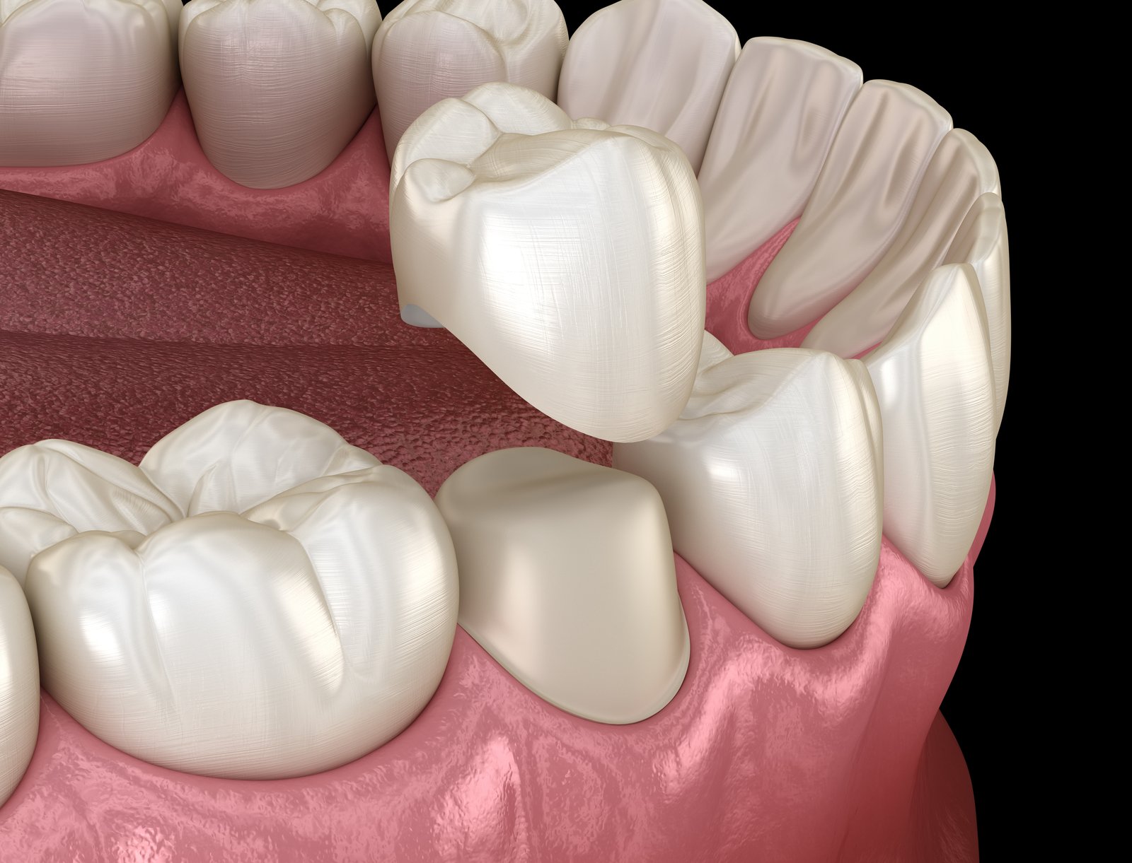 Dental Crown Photo