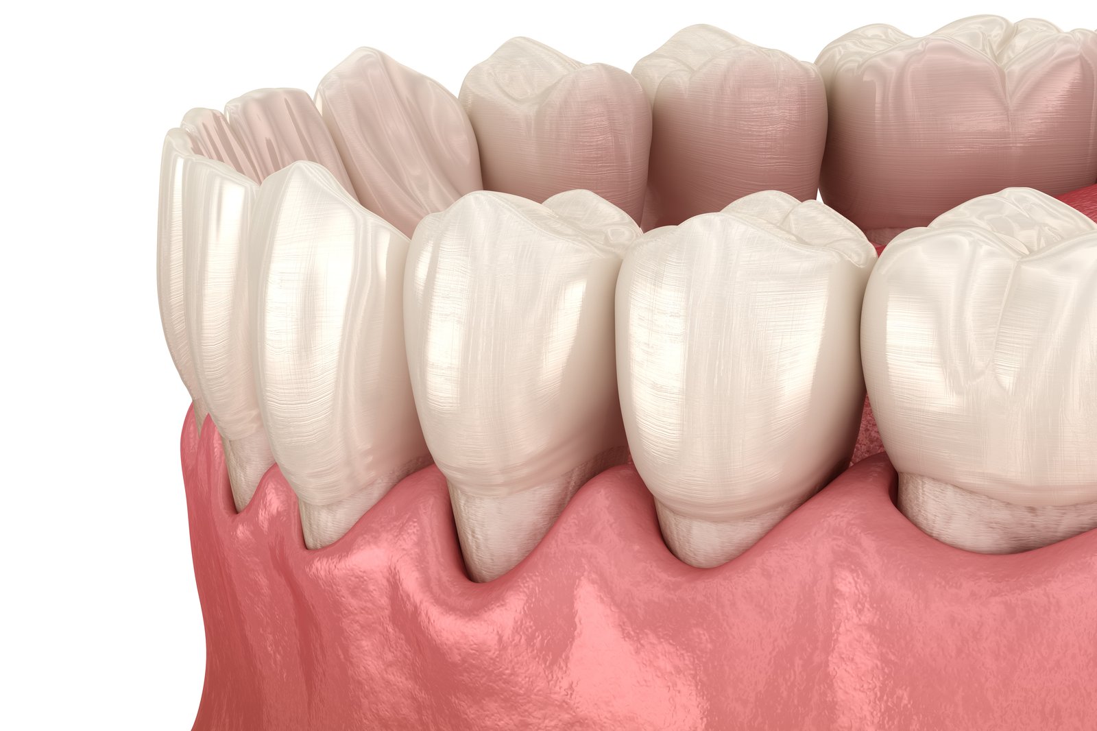 Arestin Treatment Photo