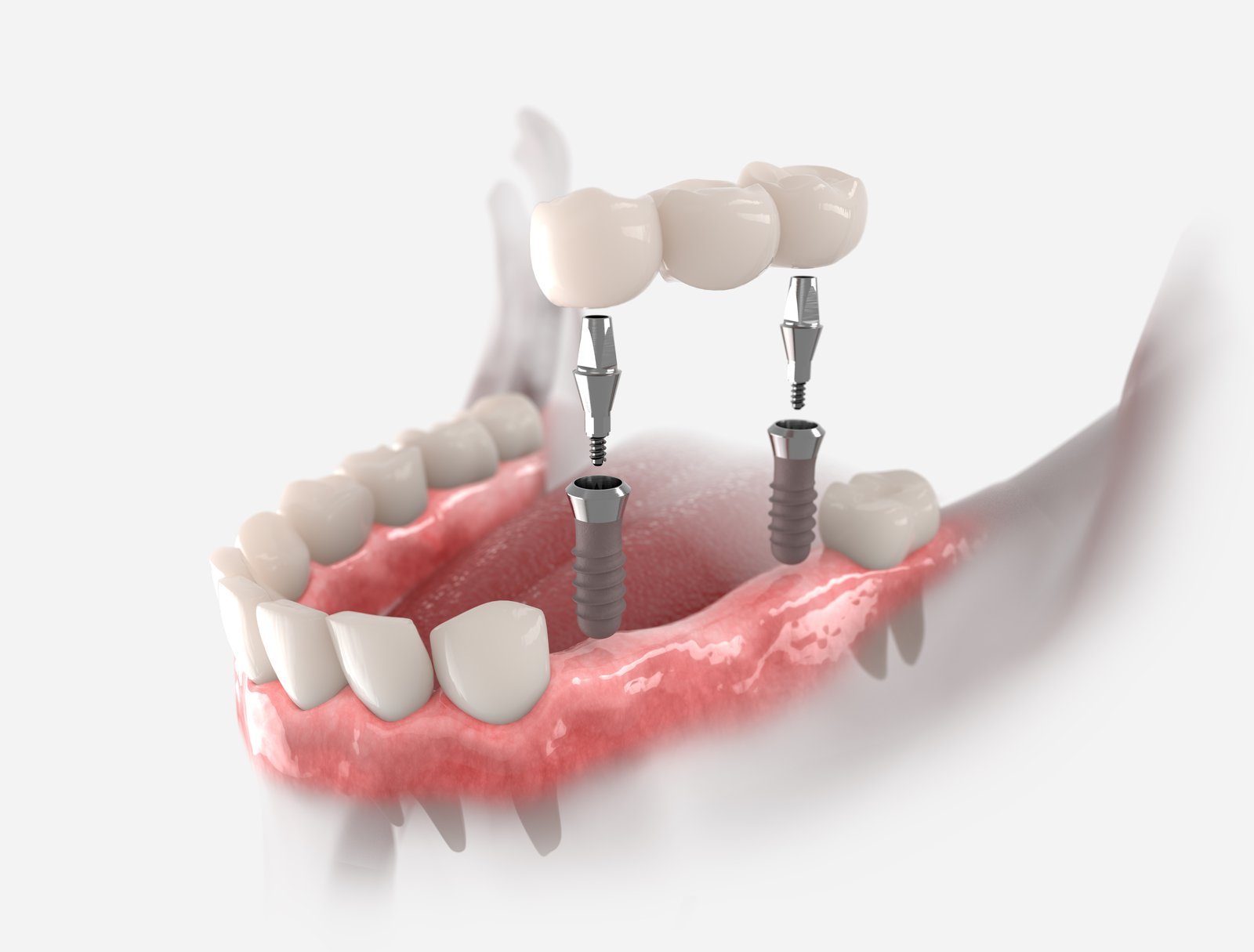 Dental Bridge Photo
