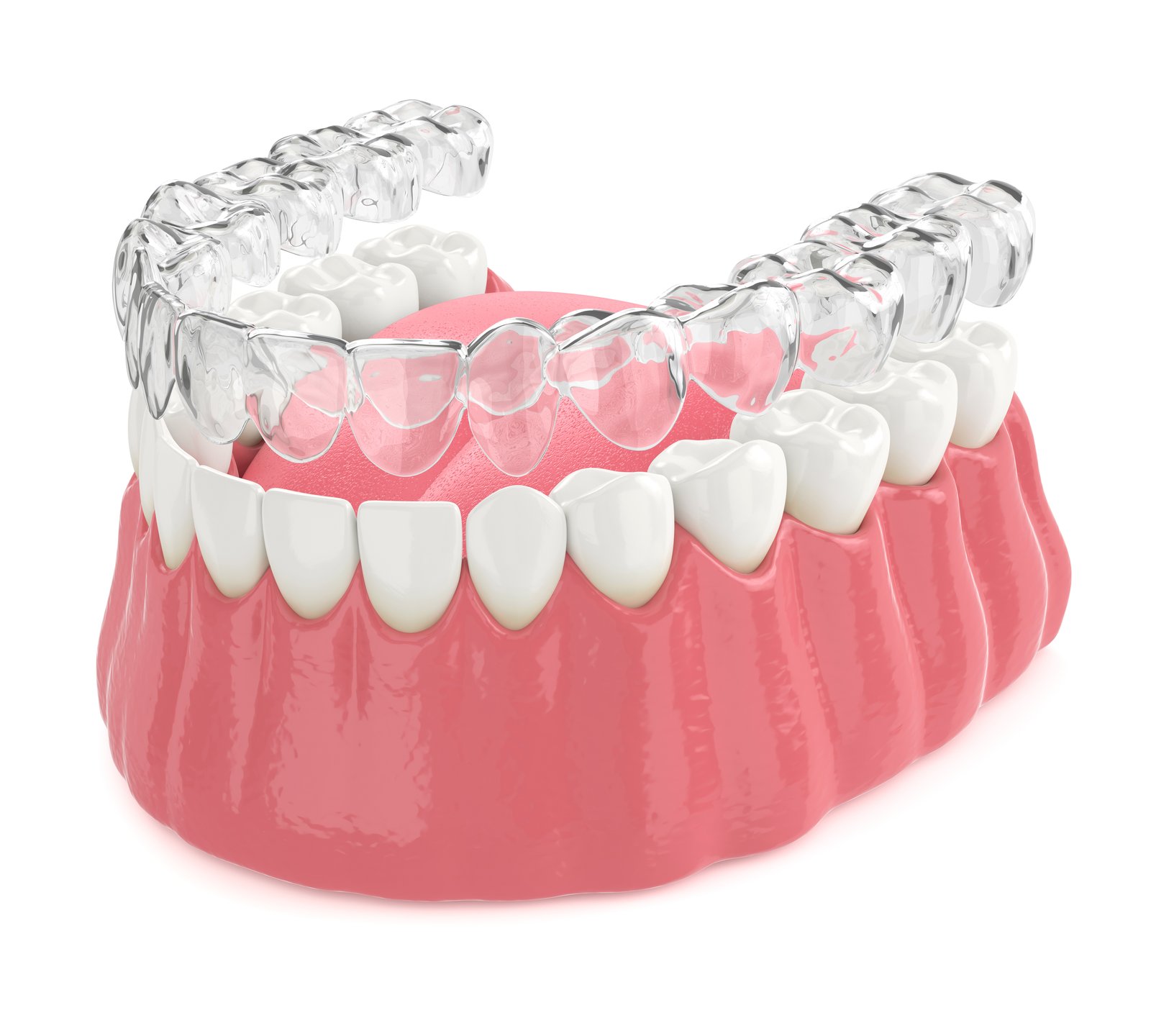 ClearCorrect Aligners in Angier NC