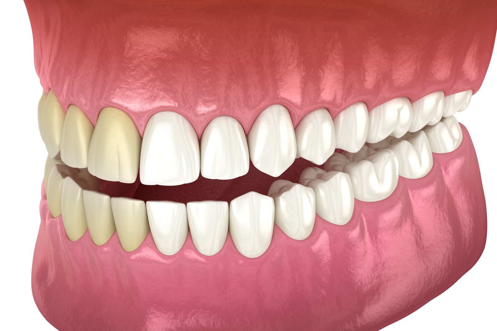 Teeth Whitening Photo