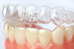 ClearCorrect Aligners: The Clear, Comfortable Way to Straighten Your Smile