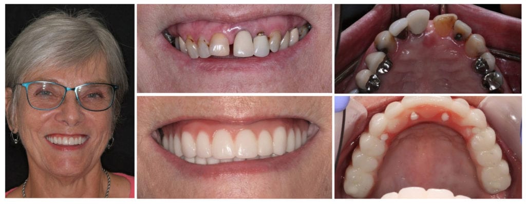 Why Your Tooth Still Hurts After a Root Canal in Angier