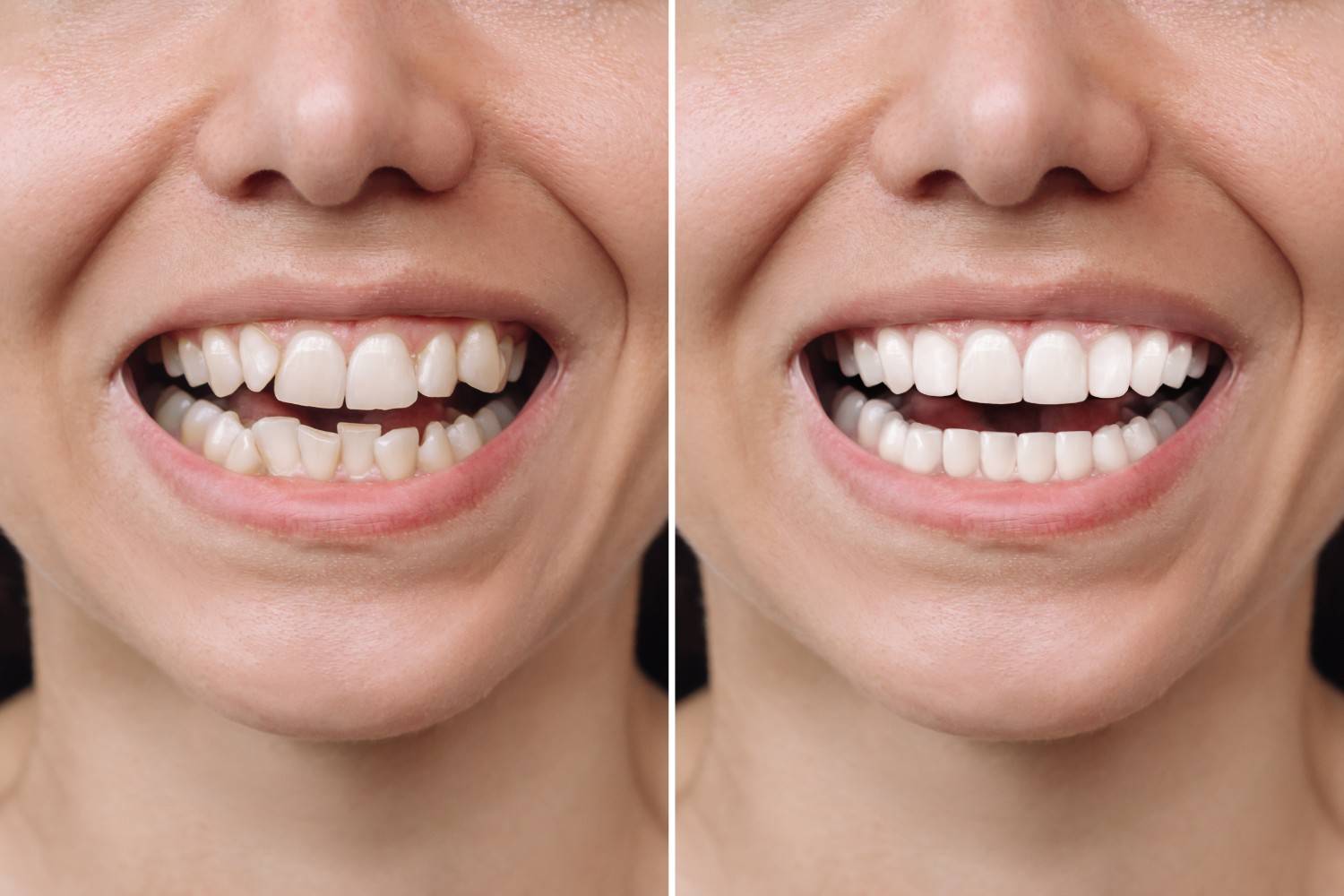 Why Isn’t My Smile Getting Whiter with Toothpaste Alone?