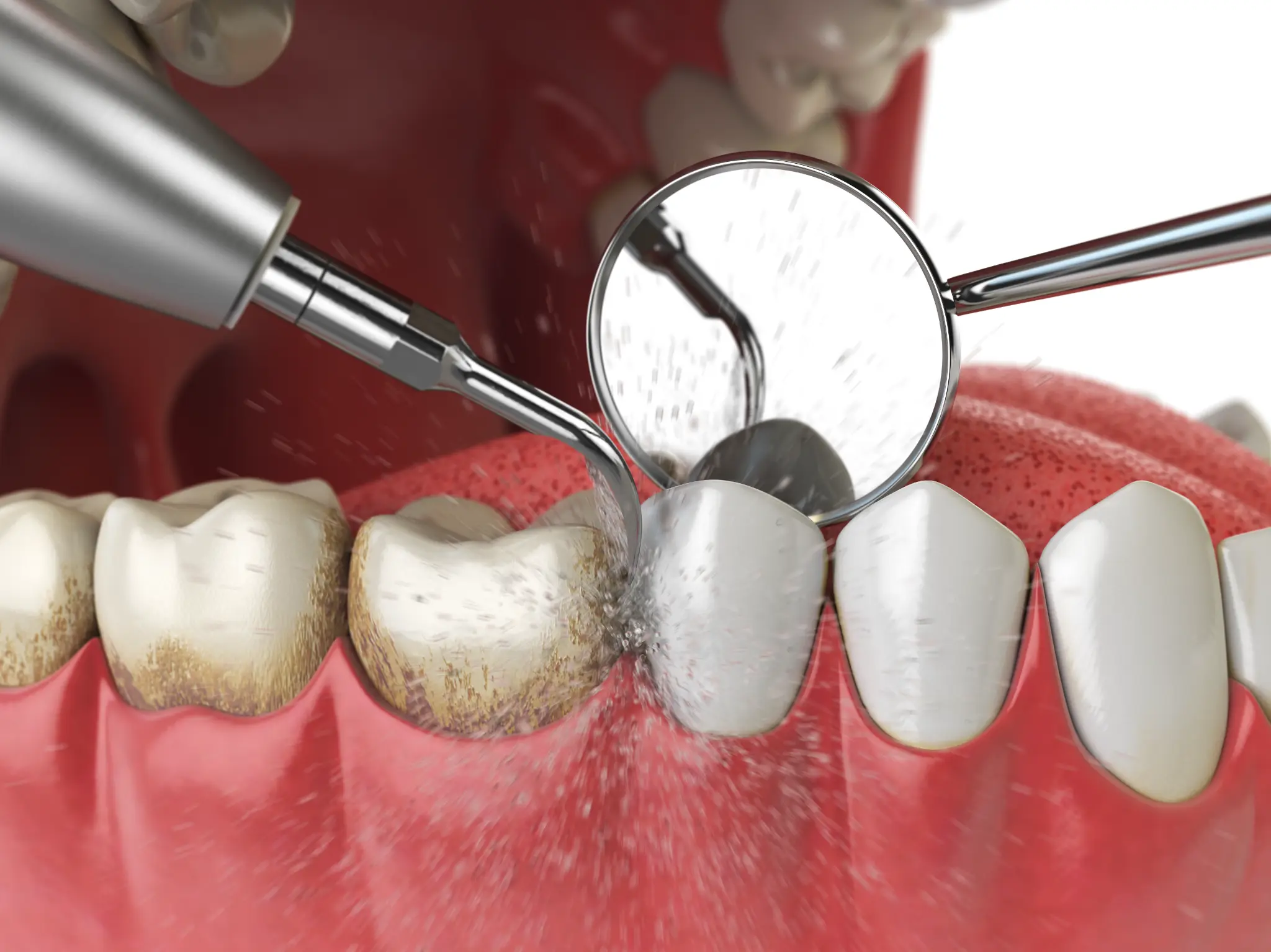 Dental cleaning and polishing at Accent Family Dentistry