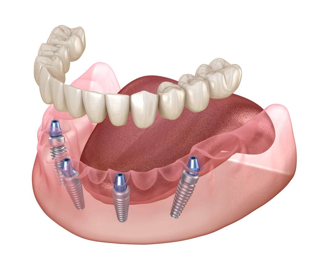 Mandibular prosthesis All on 4 system supported by implants. Med Mandibular prosthesis All on 4 system supported by implants. Medically accurate 3D illustration of human teeth and dentures concept