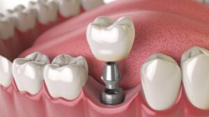 3D illustration the process of dental implant. Crown, abutment, screw. 3D illustration the process of dental implant. Crown, abutment, screw.